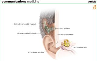 1ère étude européenne sur les bénéfices des implants totalement implantables