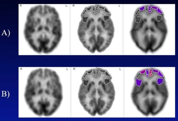 Les aides auditives ralentiraient le déclin métabolique du cerveau