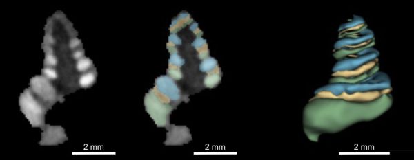 Une micro-aiguille imprimée en 3D pourrait révolutionner les traitements des surdités